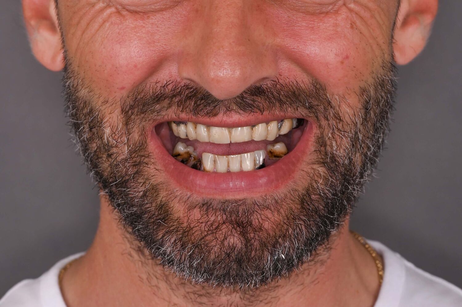 Pacient Clinica Dr. Alin Odor - Rezultat Implantologie